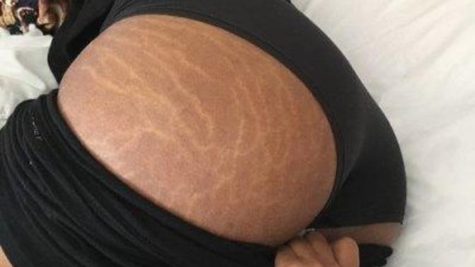 Do you mind if the girl you are dating has stretch marks on her butt?