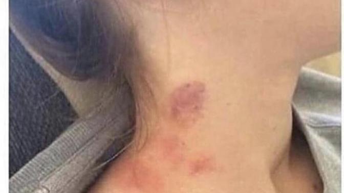 I get a fight with my boyfriend because of hickeys?