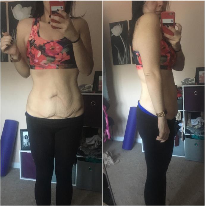 Guys, would you date a girl who has loose skin from massive weight loss?