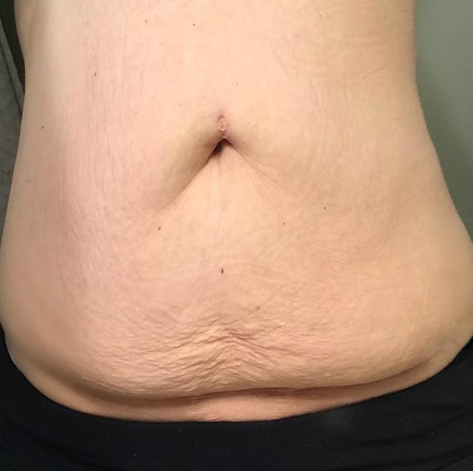 Guys, would you date a girl who has loose skin from massive weight loss?