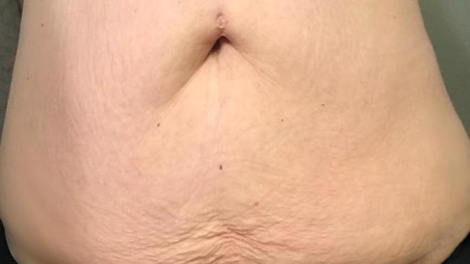 Guys, would you date a girl who has loose skin from massive weight loss?