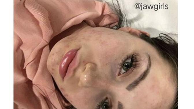 Acne does not make you ugly, Do you agree or disagree?