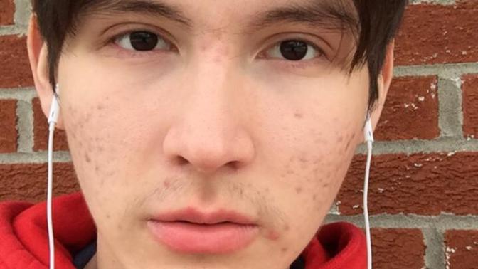 Girls, I think that im ugly because of my acne. Is it bad?