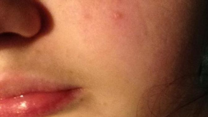 Should I see a doctor about this acne?