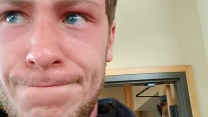 I got burnt as shit on my spring break trip lol. Does it make my eyes stand out?