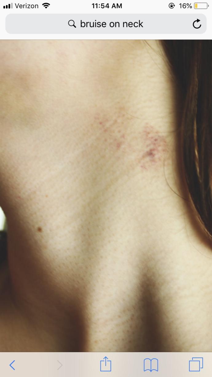 A hickey or something else?