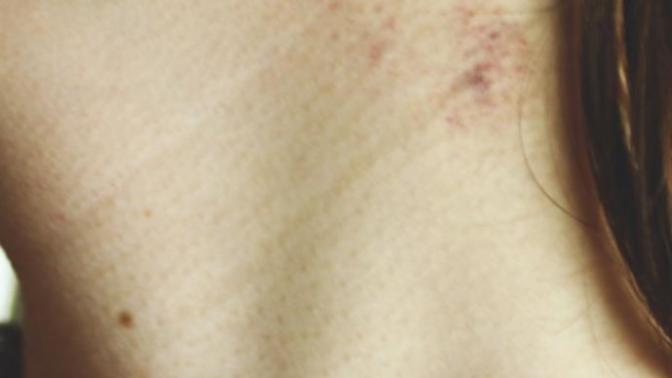 A hickey or something else?