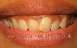 Insecure about my teeth?