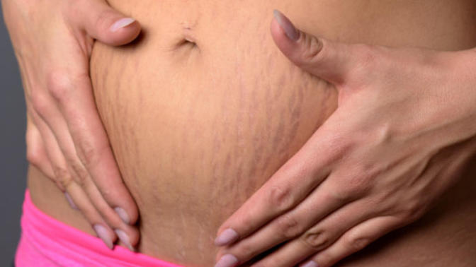 What do guys think of stretch marks on women?