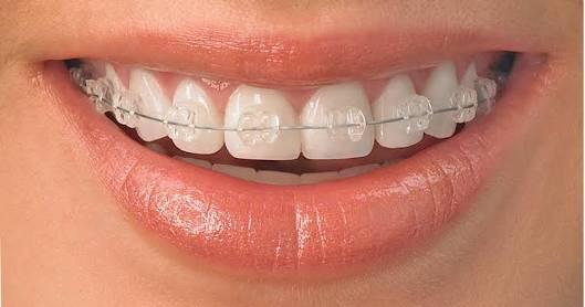 Ceramic braces or metal braces?
