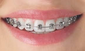 Ceramic braces or metal braces?