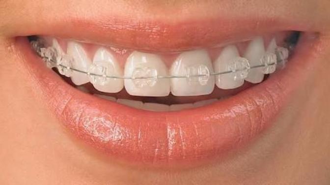 Ceramic braces or metal braces?