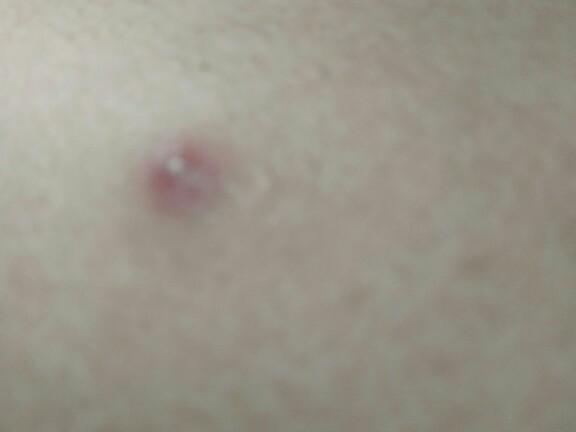Does this look like cancer bumps??