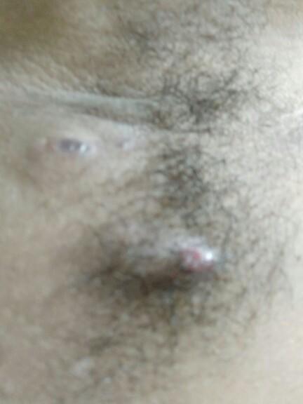 Does this look like cancer bumps??
