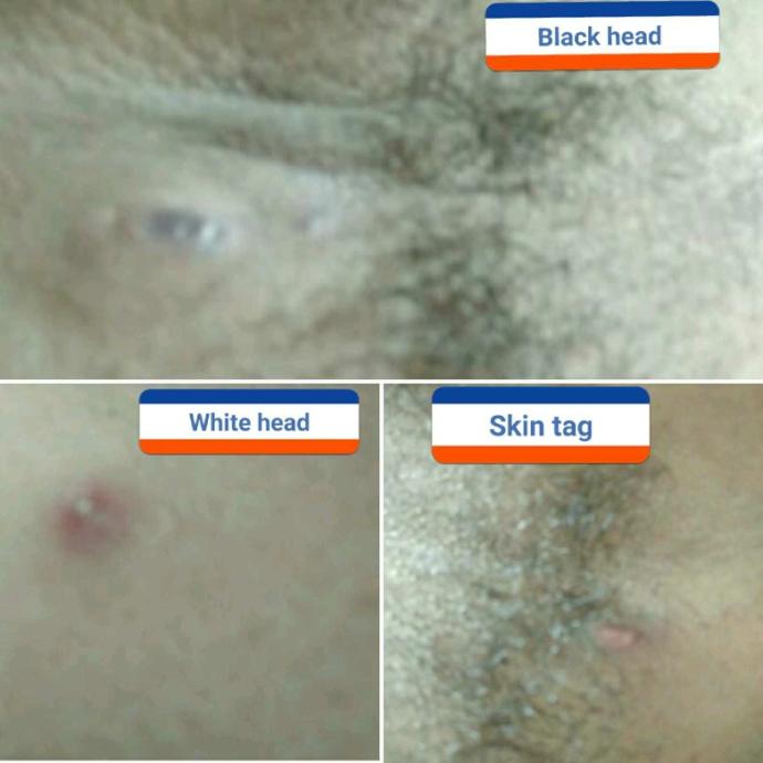 Does this look like cancer bumps?