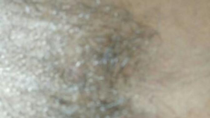 Does this look like cancer bumps?