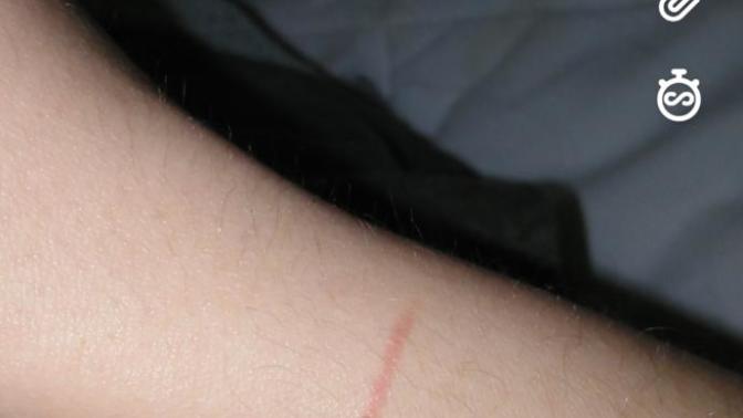 What is this red line on my arm?