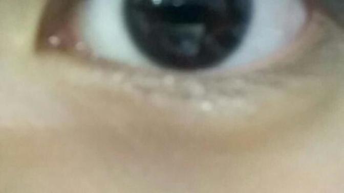 How can I get back my normal eyelids?
