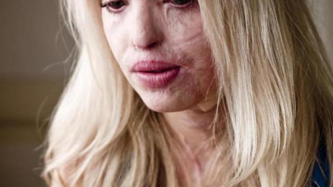 If your partner’s face was badly disfigured by acid, would you stay with them or leave?