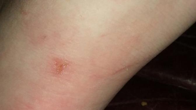 IS THIS A SPIDER BITE?