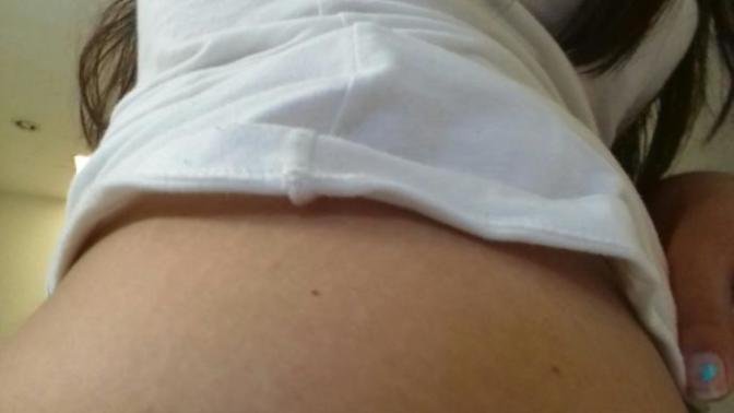 Do my stretch marks look bad?