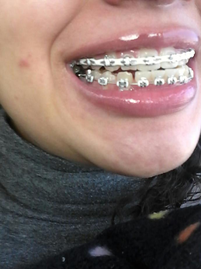 Do I mostly look like I could take off my braces?