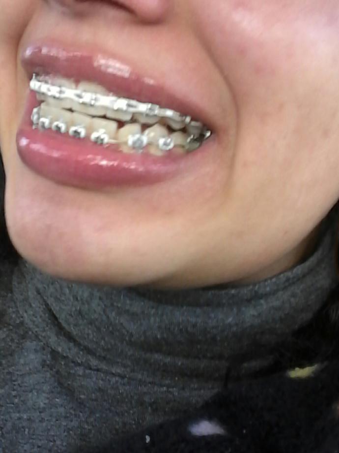 Do I mostly look like I could take off my braces?