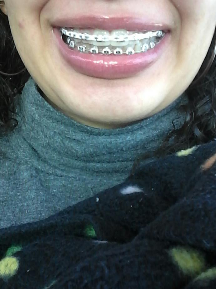 Do I mostly look like I could take off my braces?