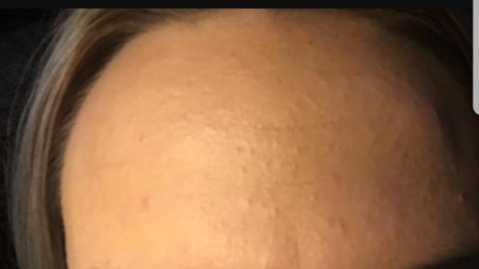How much is this acne a turn off?