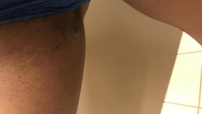 What is this lump on my bikini line and how do I get rid of it?