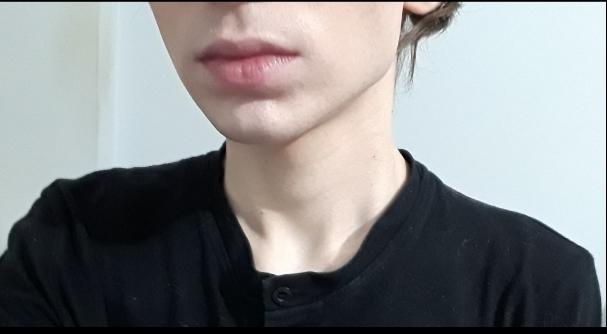 Do you think I got rid of my acne scars?