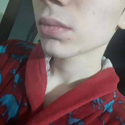 Do you think I got rid of my acne scars?