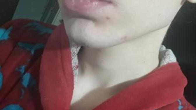 Do you think I got rid of my acne scars?