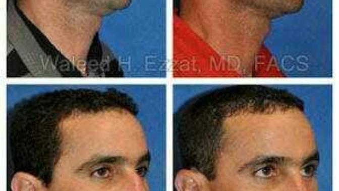 If someone has a nose job will their kids have big noses as well?