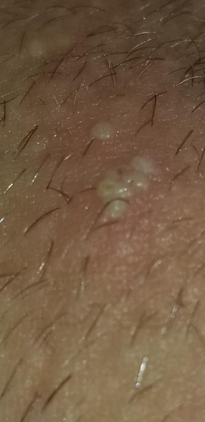 Is this herpes sorry for the image but anyone who has it Is this it?
