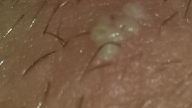 Is this herpes sorry for the image but anyone who has it Is this it?