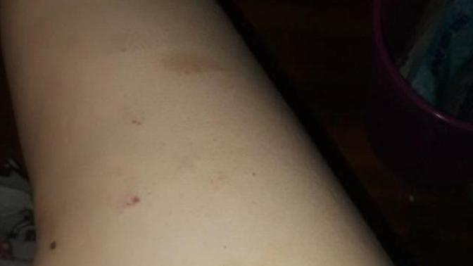 What can I do to hide or get rid of my bruises fast I have graduation next Saturday but I have these bruises on my thighs?