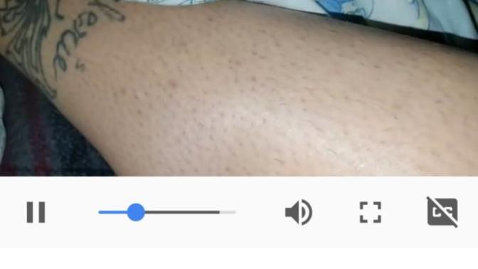 Girls, does epilating cause "strawberry legs" as a sample like this?