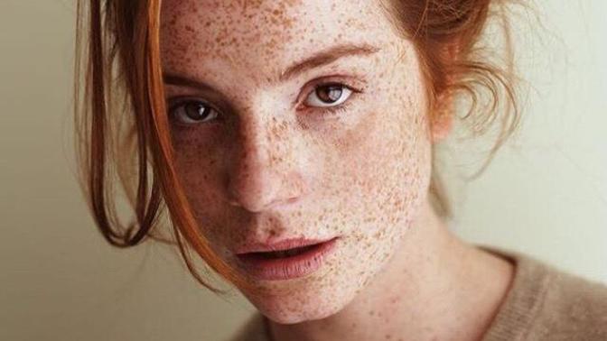 Have you ever seen a person that has freckles all over the face in real-life?