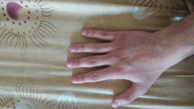 I have small hands for a man , is there any surgery to increase my fingers length?