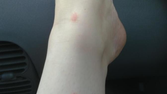 What the heck is on my leg?