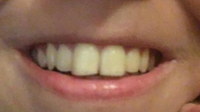 I have a problem in smiling because of my 2 front teeth... as you can see they have a small gap down in between. what do you think I need for this?