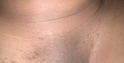 dark marks on vagina Dark marks on vagina