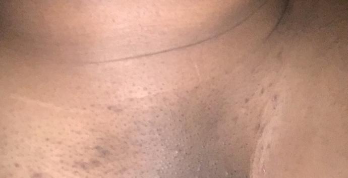 How To Get Rid Of These Dark Scars On Your Vagina?