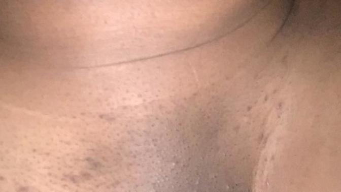 How To Get Rid Of These Dark Scars On Your Vagina?