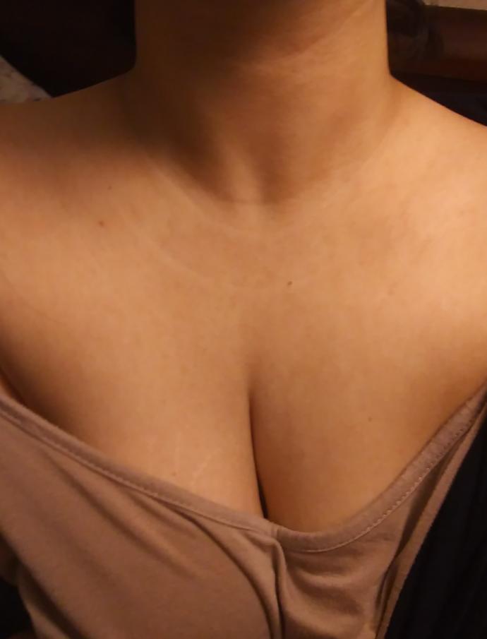 Are light stretch marks or blemishes near the chest a turn off?