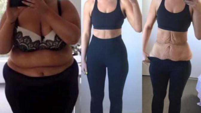 If I lose 20 pounds, will I have excessive skin like we see from overweight to healthy transformation people on the internet losing 200-300 pounds?