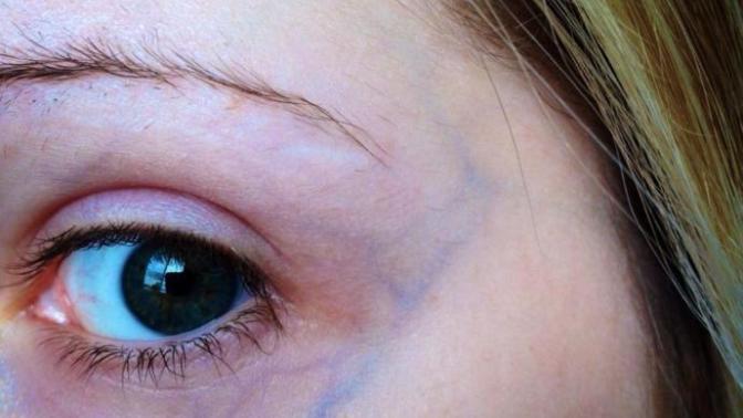 What could be causing visible and green/blue veins on my face?