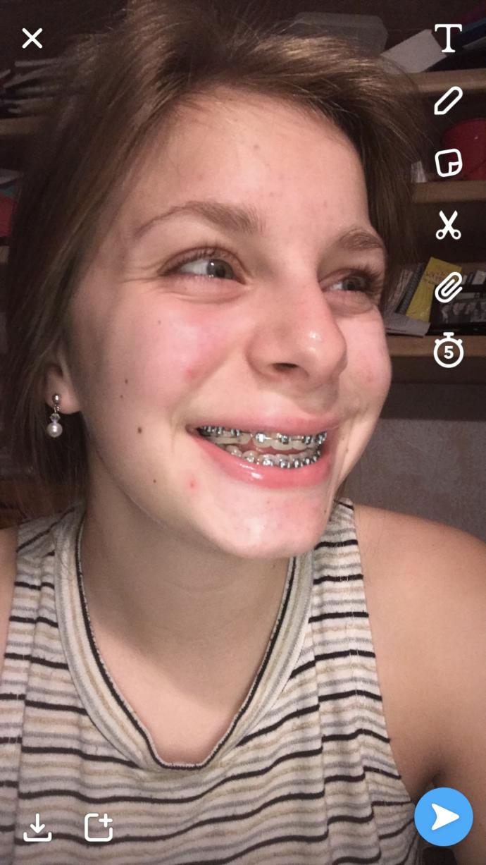 Getting braces off and I’m nervous?