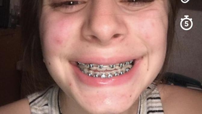 Getting braces off and I’m nervous?